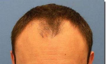 Hair restoration procedure results