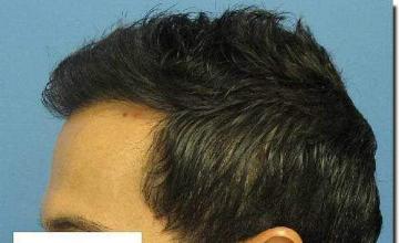 Hair restoration procedure results