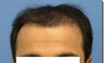 Hair restoration procedure results