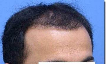 Hair restoration procedure results