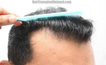 Hair restoration procedure before and after results