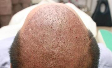 Hair transplantation surgery before and after images