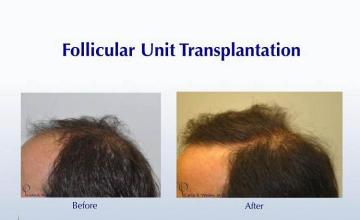 Hair transplantation surgery before and after pictures