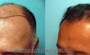 Hair transplantation surgery before and after pictures