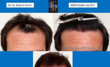 Hair restoration procedure before and after results