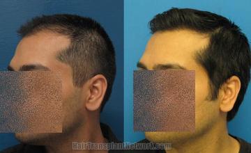 Hair transplantation surgery before and after photos