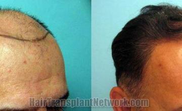 Hair transplantation surgery before and after images