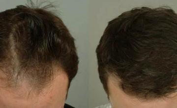 Hair transplantation surgery before and after photos