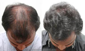 Hair restoration procedure before and after results