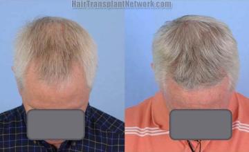 Hair transplantation surgery before and after images