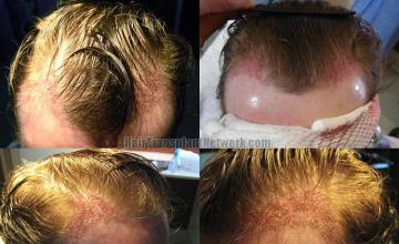 Hair restoration procedure postoperative  after photos