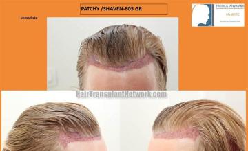 Hair transplant surgery before and after images