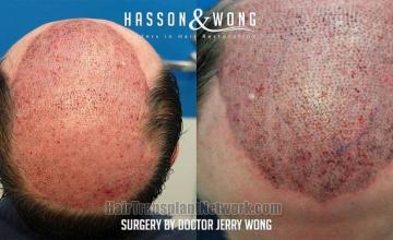 Hair restoration procedure before and after result images