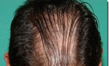 Hair restoration procedure results