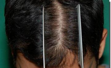 Hair restoration procedure results