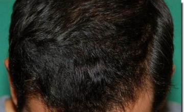 Hair restoration procedure results