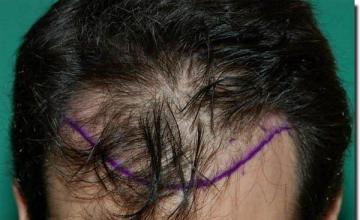 Hair restoration procedure results