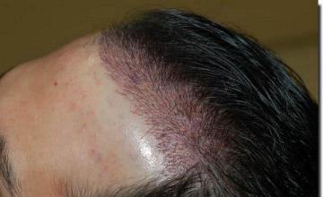 Hair restoration procedure results