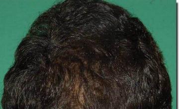 Hair restoration procedure results