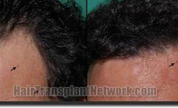 Hair restoration procedure results