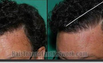 Hair restoration procedure results