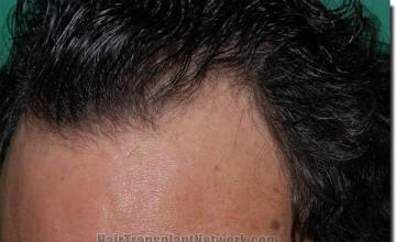 Hair restoration procedure results