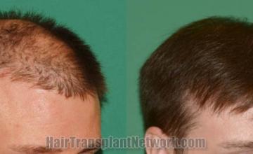 Hair transplantation procedure before and after results