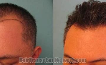 Hair restoration procedure before and after pictures