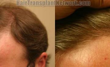 Hair transplantation surgery before and after pictures