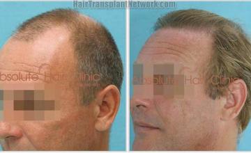 Hair transplantation surgery procedure before and after photos