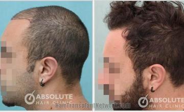 Hair transplantation surgery before and after photos