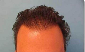 Hair restoration procedure results