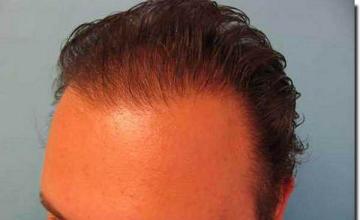 Hair restoration procedure results