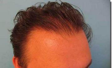 Hair restoration procedure results