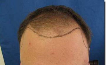 Hair restoration procedure results