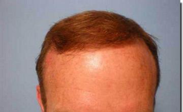 Hair restoration procedure results