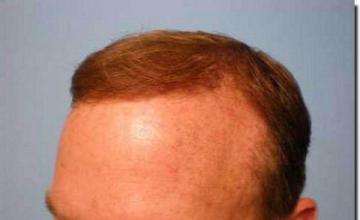 Hair restoration procedure results