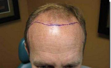 Hair restoration procedure results