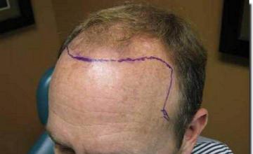 Hair restoration procedure results