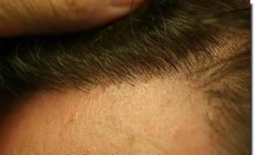 Hair restoration procedure results