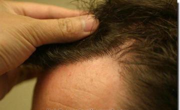 Hair restoration procedure results