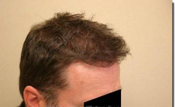 Hair restoration procedure results