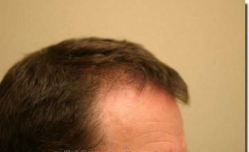 Hair restoration procedure results