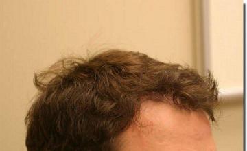 Hair restoration procedure results