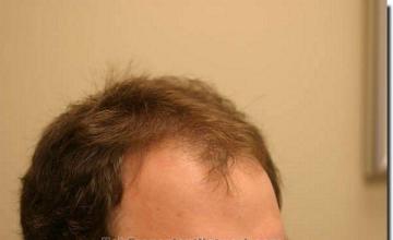 Hair restoration procedure results