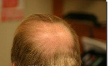 Hair restoration procedure results