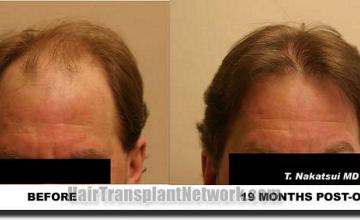 Hair restoration procedure results