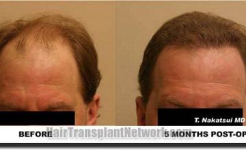 Hair restoration procedure results