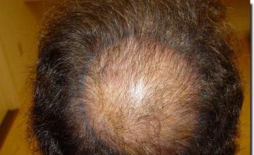 Hair restoration procedure results