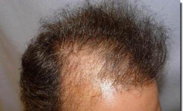 Hair restoration procedure results